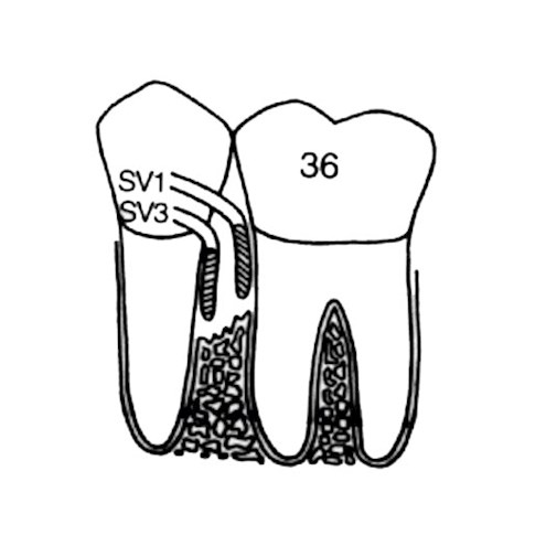 Kirety stomatologiczne (usuwanie kamienia nazębnego) LM-Instruments SV