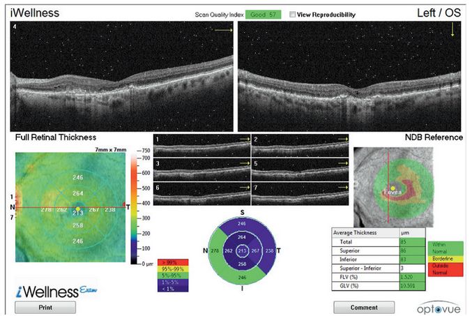 Tomografy okulistyczne (OCT) Optovue iScan80