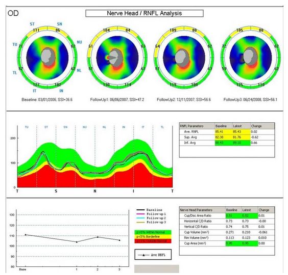 Tomografy okulistyczne (OCT) Optovue RTVue VTRAC Premier