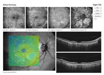 Tomografy okulistyczne (OCT) Optovue RTVue XR AVANTI