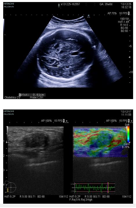 Ultrasonografy stacjonarne wielonarządowe - USG FUJIFILM ARIETTA V60