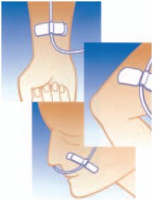 Opatrunki mocujące (cewnik, dren, kaniula) Transatlantic Transatlantic