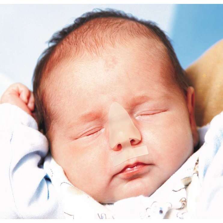 Plastry ochronno-uszczelniające dla noworodków do kaniul CPAP Kreienbaum CPAPNose