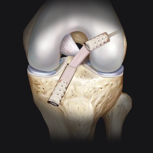 Śruby interferencyjne do artroskopii ARTHREX FastThread