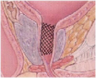 Stenty urologiczne AMS UroLume