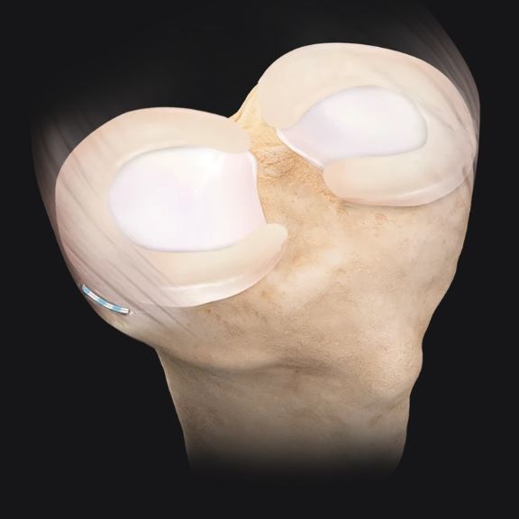 Systemy rekonstrukcji łąkotki do artroskopii ARTHREX Knee Capsule Repair