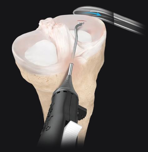 Systemy rekonstrukcji łąkotki do artroskopii ARTHREX ZoneNavigator
