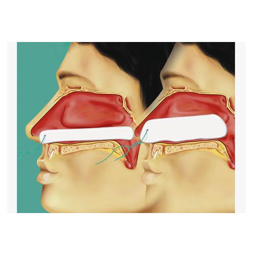 Tampony opatrunkowe (opatrunki donosowe) Lohmann & Rauscher Raucocel anatomiczna