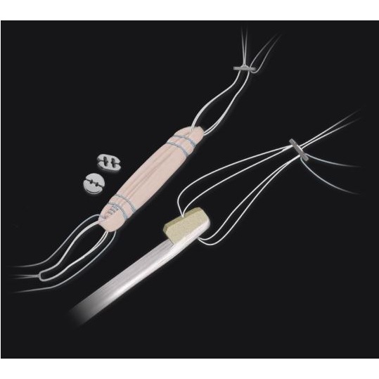 Urządzenia unieruchamiające do tkanek miękkich do artroskopii ARTHREX TightRope