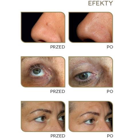 Aparaty do beziwazyjnego liftingu powiek Neauvia Devices Plasma IQ