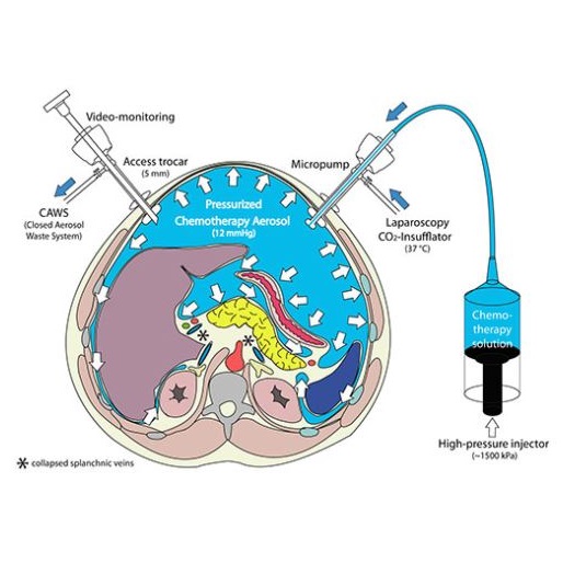 Aparaty do dootrzewnowej podciśnieniowej chemioterapii aerozolem Capnomed CapnoPen