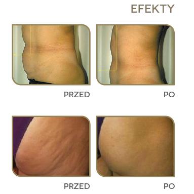 Aparaty do karboksyterapii Berger & Kraft Reology 2