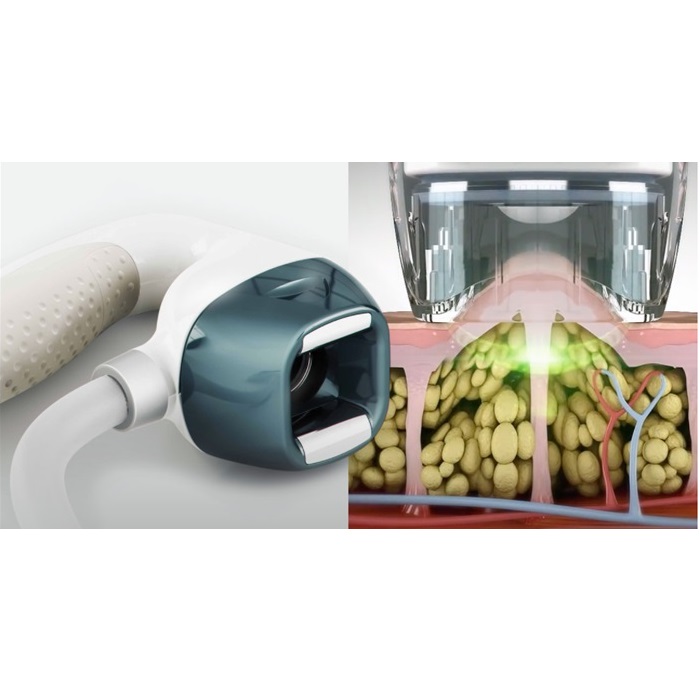 Aparaty do kosmetologii – Combo Candela VelaShape III