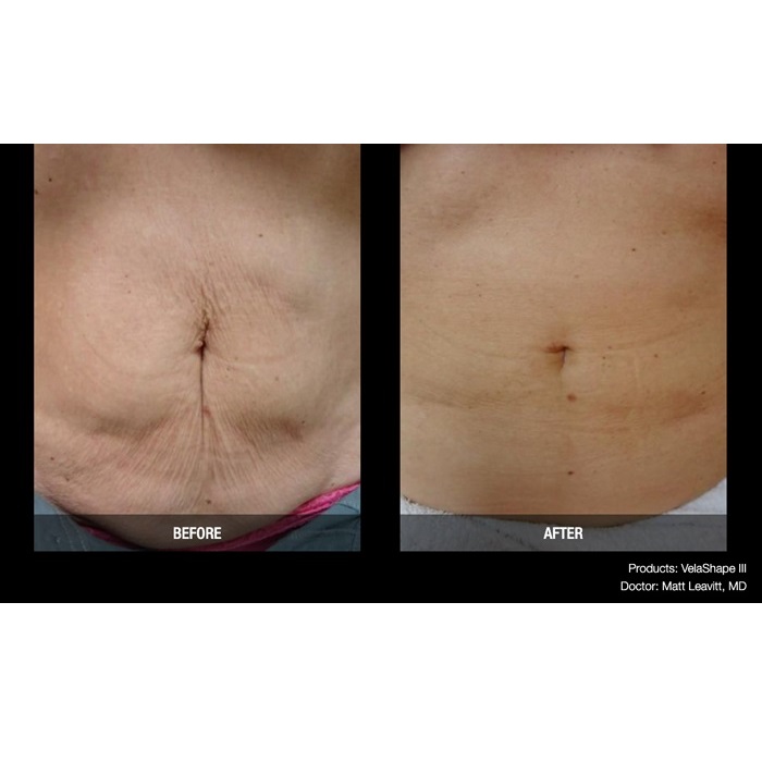 Aparaty do kosmetologii – Combo Candela VelaShape III