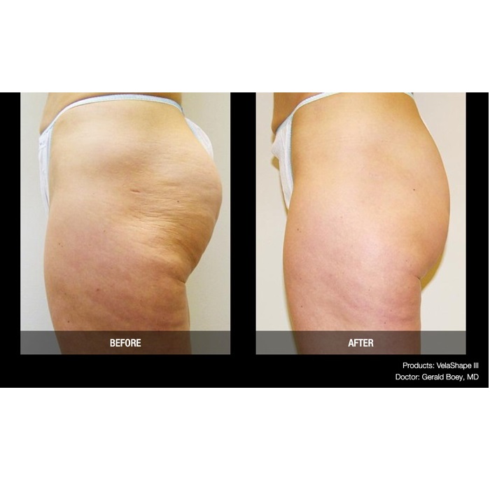 Aparaty do kosmetologii – Combo Candela VelaShape III