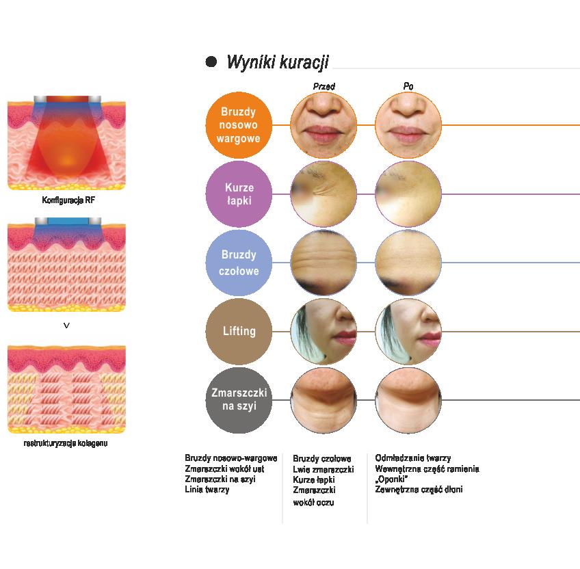 Aparaty do kosmetologii – Combo Jeisys AntiLax