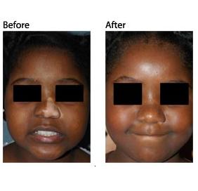 Aparaty do kosmetologii – Combo PhotoMedex VTRAC