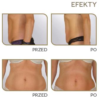 Aparaty do radiofrekwencji Neauvia Devices Sectum