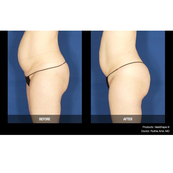 Aparaty do redukcji cellulitu i modelowania sylwetki Candela VelaShape III