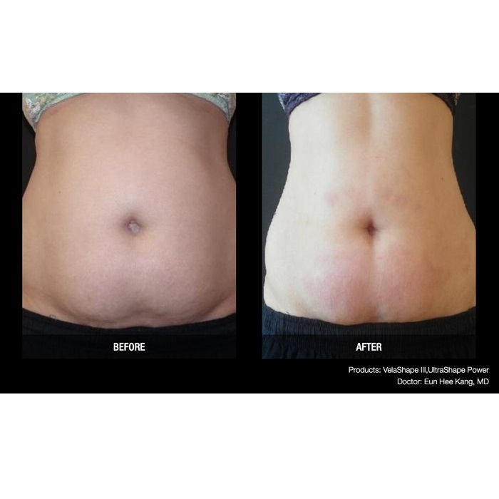 Aparaty do redukcji cellulitu i modelowania sylwetki Candela VelaShape III