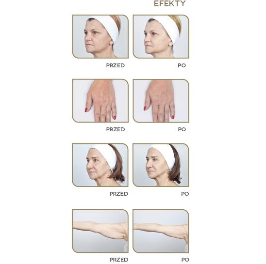 Aparaty do redukcji cellulitu i modelowania sylwetki Neauvia Devices Zaffiro