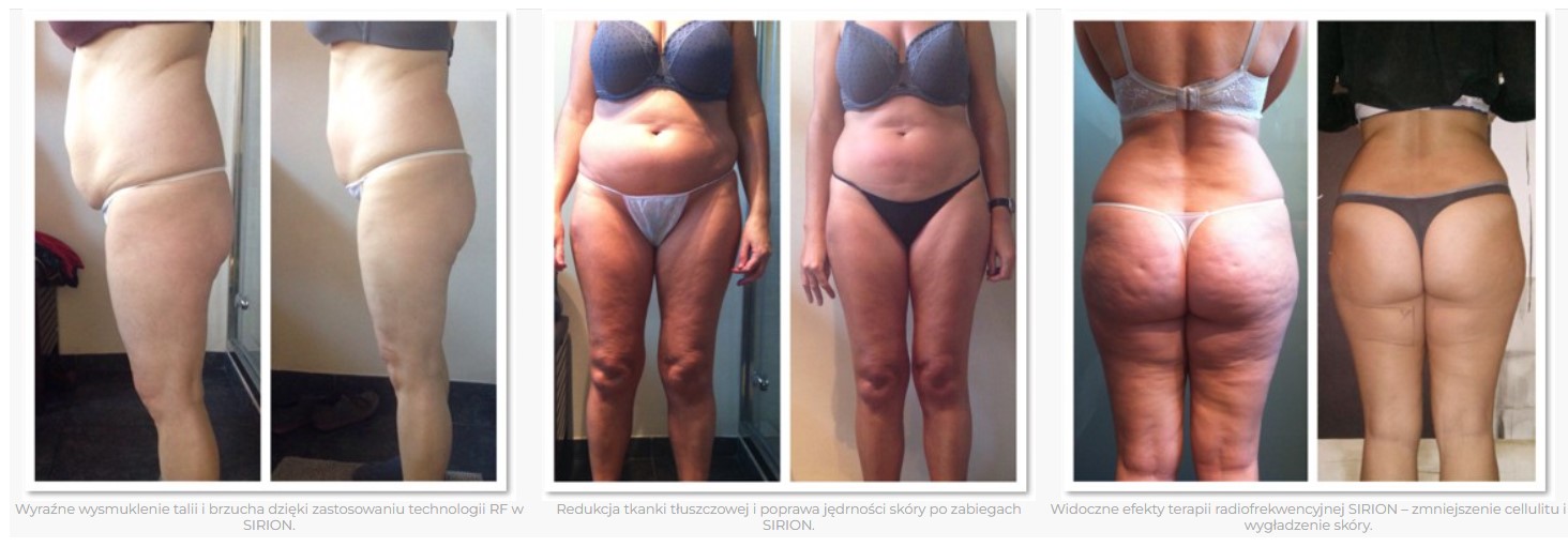 Aparaty do redukcji cellulitu i modelowania sylwetki Sayton Medical SIRION