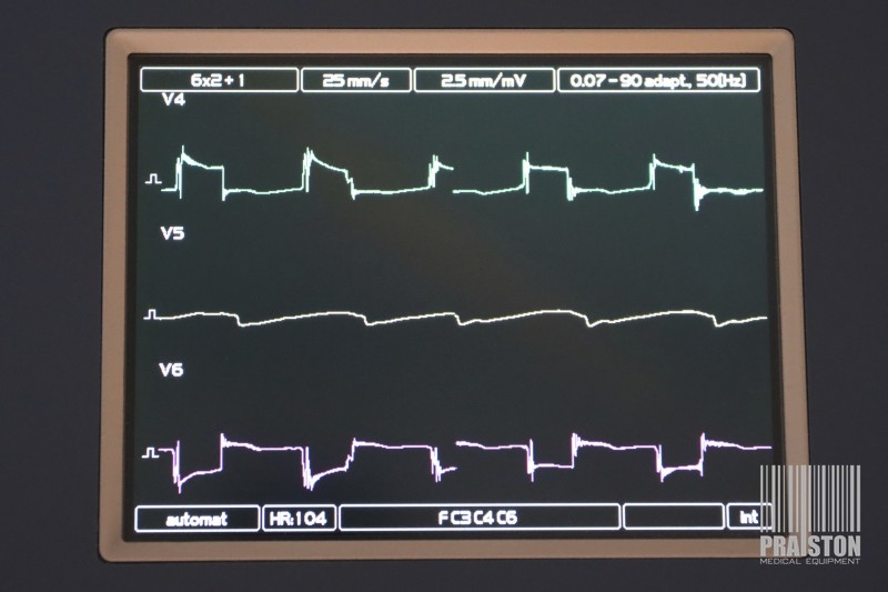 Aparaty EKG - Elektrokardiografy używane B/D BTL 08 MT Plus - Praiston rekondycjonowany