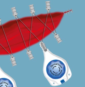 Ekspandery tkankowe do zamykania ran DermaClose DermaClose