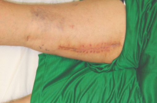 Ekspandery tkankowe do zamykania ran DermaClose DermaClose