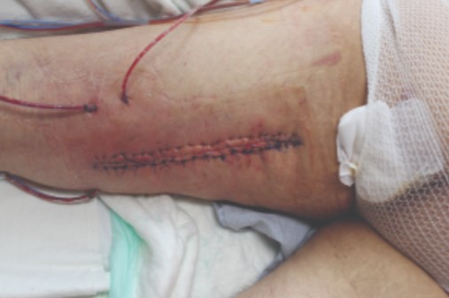 Ekspandery tkankowe do zamykania ran DermaClose DermaClose