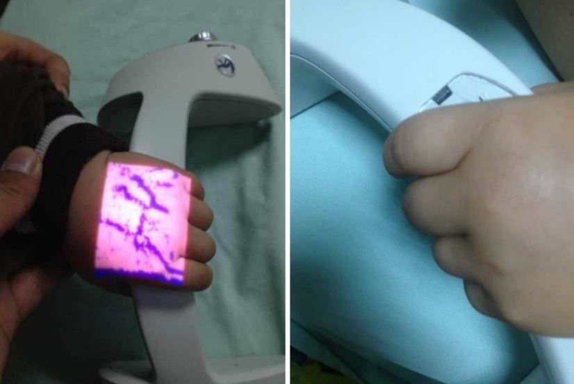 Iluminatory naczyniowe (skanery żył) ZD - Medical Inc. JM-260-04