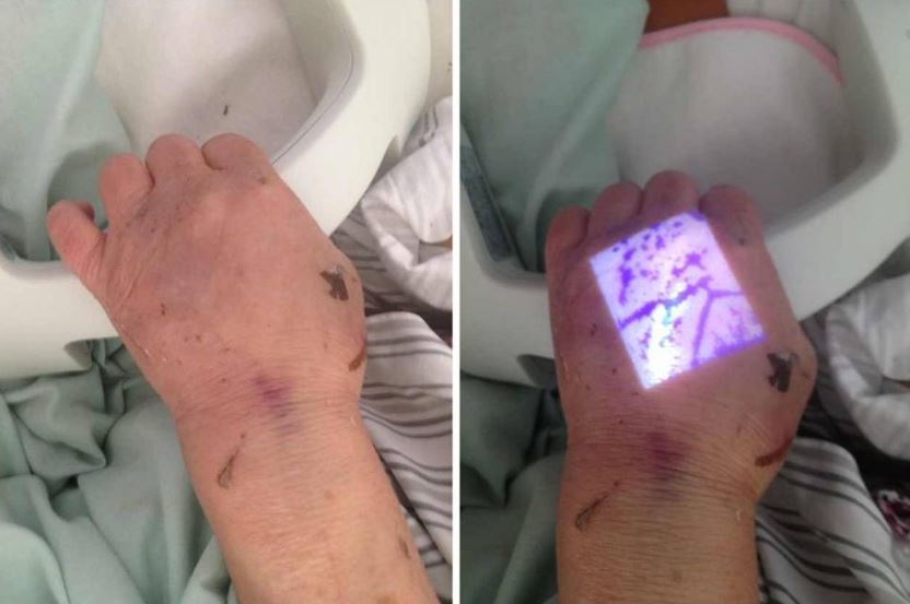 Iluminatory naczyniowe (skanery żył) ZD - Medical Inc. JM-260-04