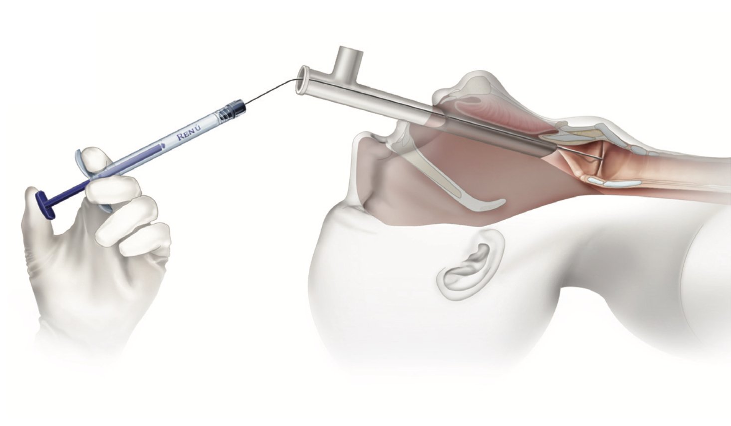 Implanty iniekcyjne laryngologiczne Soluvos Medical Renu Voice