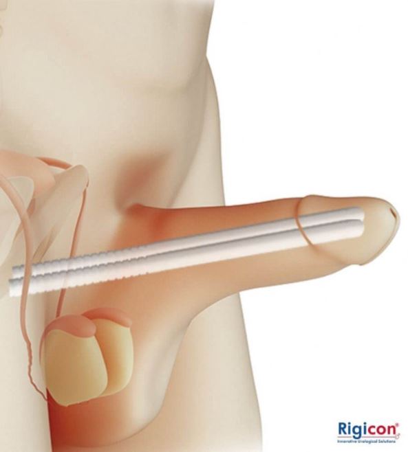 Implanty (protezy) prącia Rigicon Elektrody do elektroresekcji