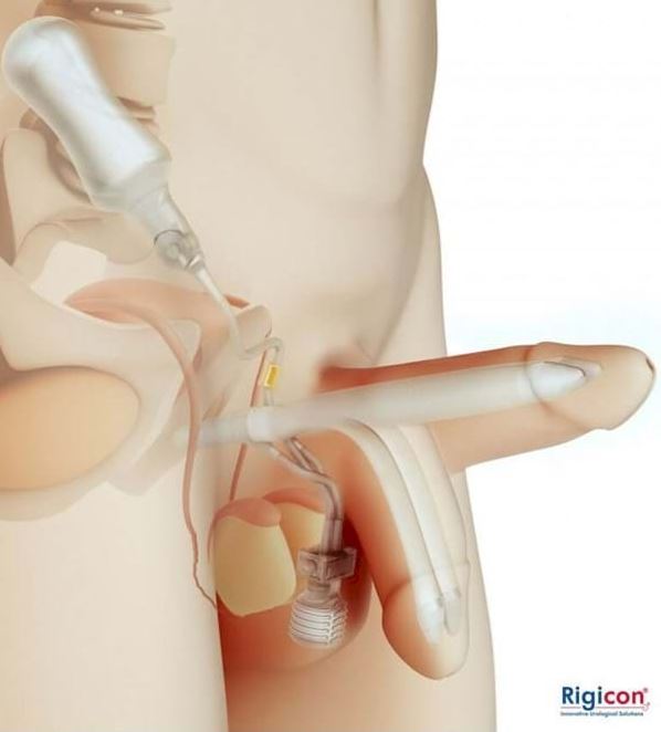 Implanty (protezy) prącia Rigicon Elektrody do elektroresekcji