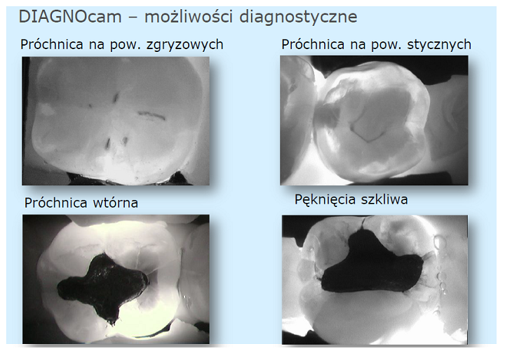 Kamery wewnątrzustne laserowe KaVo DiagnoCam