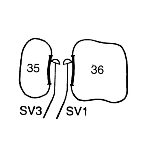 Kirety stomatologiczne (usuwanie kamienia nazębnego) LM-Instruments SV