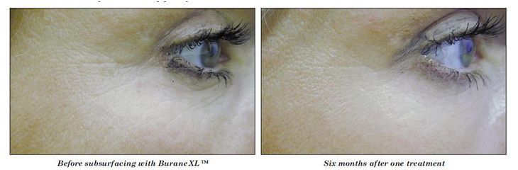 Lasery dermatologiczne Alma Lasers BURANE i BURANE XL
