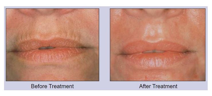 Lasery dermatologiczne Alma Lasers BURANE i BURANE XL