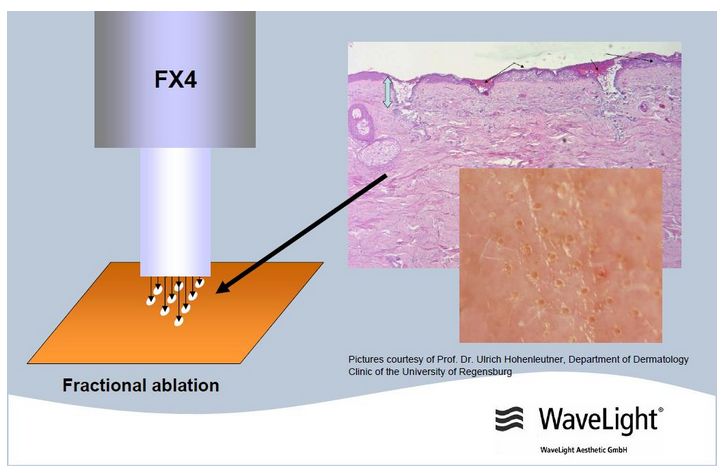 Lasery dermatologiczne Alma Lasers BURANE i BURANE XL