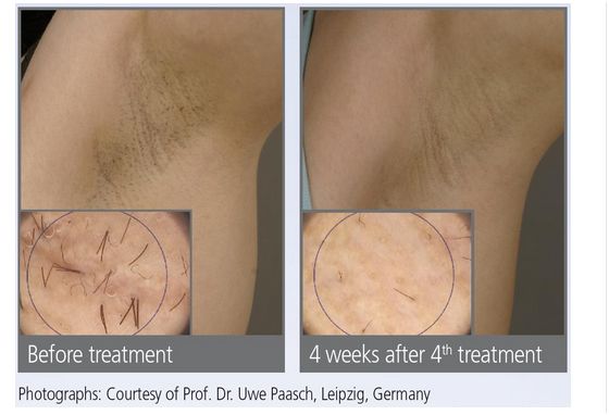 Lasery dermatologiczne Alma Lasers LEDA EPI 808NM