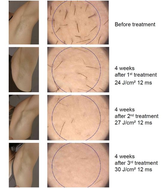 Lasery dermatologiczne Alma Lasers LEDA EPI 808NM