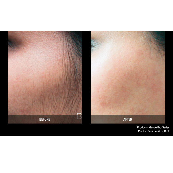 Lasery dermatologiczne Candela GentlePro