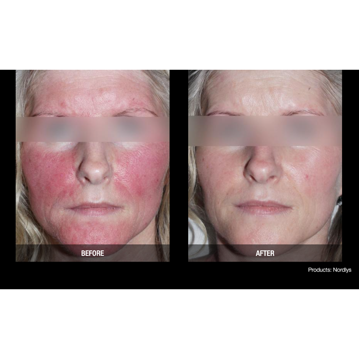 Lasery dermatologiczne Candela Nordlys