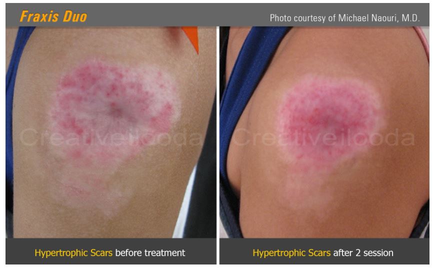 Lasery dermatologiczne Classys Fraxis DUO