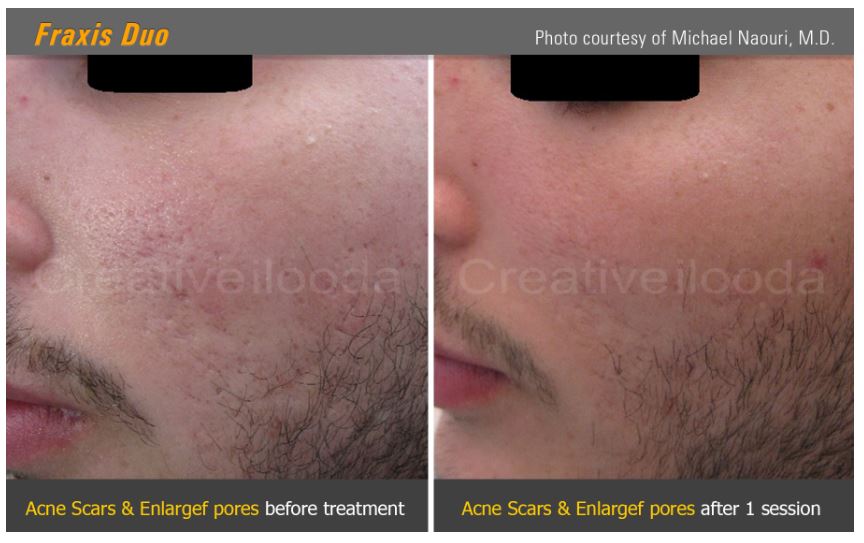 Lasery dermatologiczne Classys Fraxis DUO