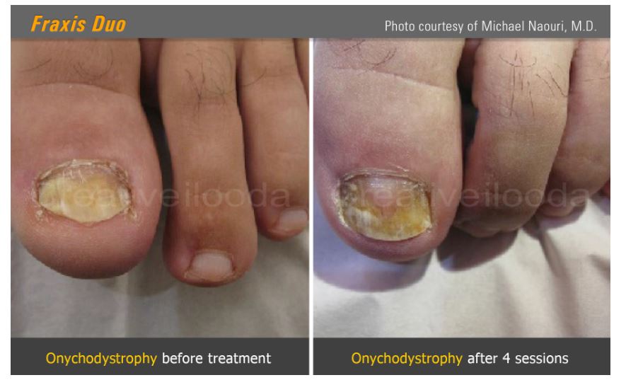 Lasery dermatologiczne Classys Fraxis DUO
