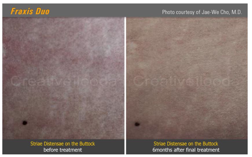 Lasery dermatologiczne Classys Fraxis DUO