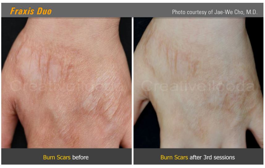 Lasery dermatologiczne Classys Fraxis DUO