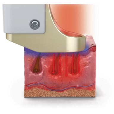 Lasery dermatologiczne CUTERA Excel HR